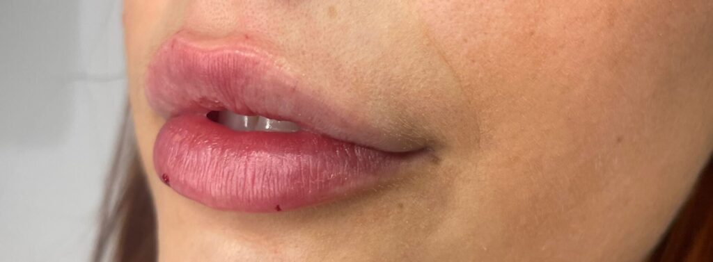 Lip fillers Rhiwbina Cardiff Lip fillers Rhiwbina Cardiff