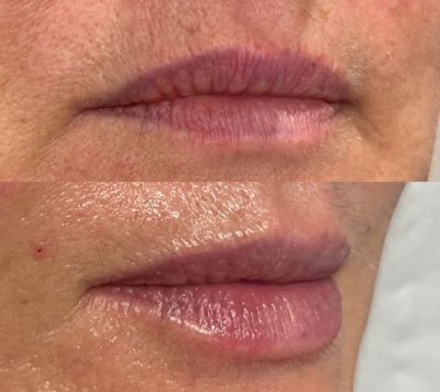 Lip-Fillers-Before-and-After-Rhiwbina-Cardiff-aesthetics-clinic