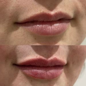 Lip-Fillers-Before-and-After-Rhiwbina-Cardiff-aesthetics