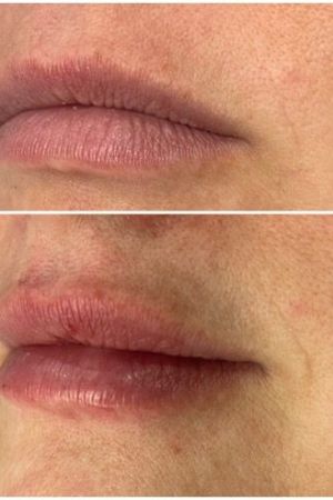 Lip-Fillers-Before-and-After-Rhiwbina-Cardiff
