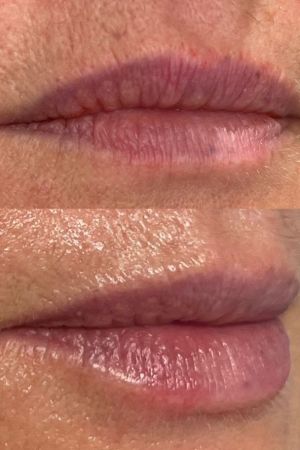 Lip-Fillers-Before-and-After-Rhiwbina-Cardiff-aesthetics-clinic