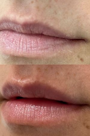 Lip-Fillers-Before-and-After-Rhiwbina-Cardiff-aesthetics-service