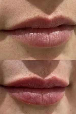 Lip-Fillers-Before-and-After-Rhiwbina-Cardiff-aesthetics