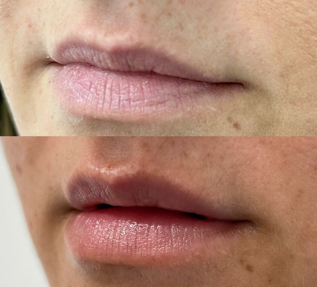 Lip-Fillers-Before-and-After-Rhiwbina-Cardiff-aesthetics-service