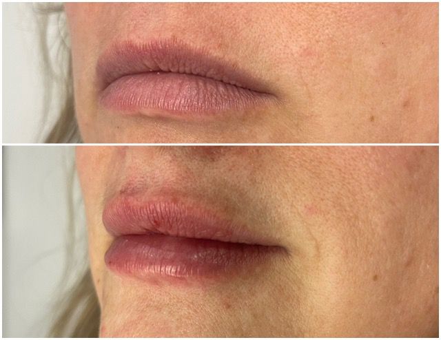 Lip-Fillers-Before-and-After-Rhiwbina-Cardiff